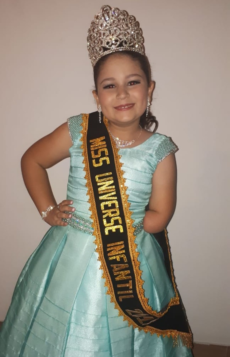 Milena nasceu com agenesia no antebraço esquerdo.