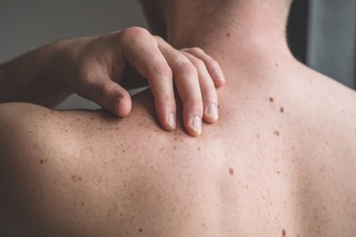 O objetivo da ação é atender a população e atentar quanto ao diagnóstico precoce do câncer de pulmão, de pele e melanoma.