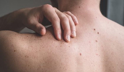 O objetivo da ação é atender a população e atentar quanto ao diagnóstico precoce do câncer de pulmão, de pele e melanoma. (Foto: Getty Images/iStockphoto)