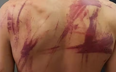Adolescente ficou com hematomas nas costas devido às agressões. (Foto: Divulgação/Polícia Civil) Adolescente ficou com hematomas nas costas devido às agressões. (Foto: Divulgação/Polícia Civil)