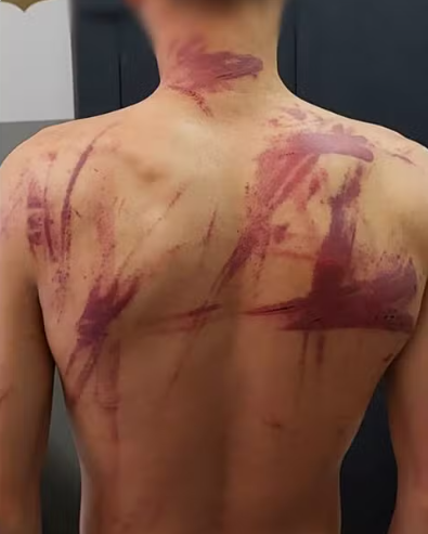 Adolescente ficou com hematomas nas costas devido às agressões.