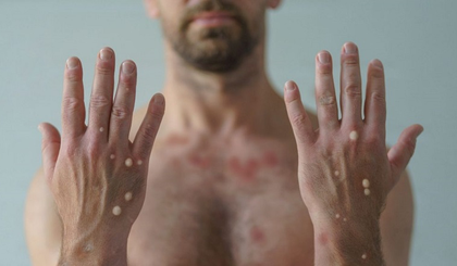Brasil registra mais de 1,5 mil casos de Mpox em 2024 (Foto: reprodução/Prefeitura de Gurupi) Brasil registra mais de 1,5 mil casos de Mpox em 2024 (Foto: reprodução/Prefeitura de Gurupi)