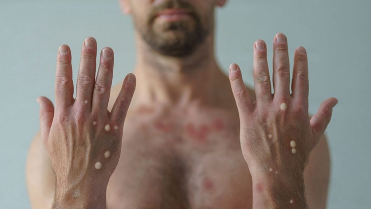 Brasil registra mais de 1,5 mil casos de Mpox em 2024