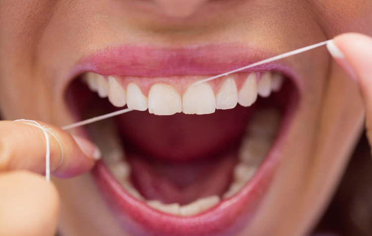Uso semanal de fio dental pode reduzir riscos de AVC e arritmia.