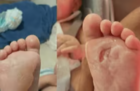 Bebê queima os dois pés em creche no interior de São Paulo (Foto: Reprodução) Bebê queima os dois pés em creche no interior de São Paulo (Foto: Reprodução)