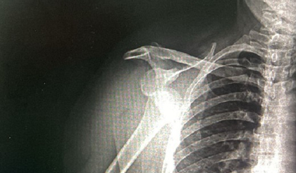 João Pedro Bispo Filho teve que passar por um procedimento para retornar a clavícula ao seu devido lugar. (Foto: Reprodução) João Pedro Bispo Filho teve que passar por um procedimento para retornar a clavícula ao seu devido lugar. (Foto: Reprodução)