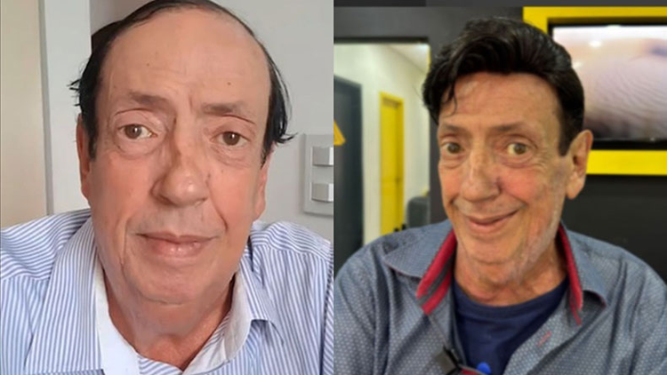 Marcos Oliveira faz implante capilar e ganha casa no Retiro dos Artistas