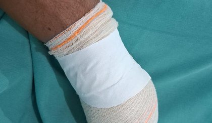 Homem tem a mão decepada após briga por terreno em Campo Maior (PI). (Foto: Reprodução)