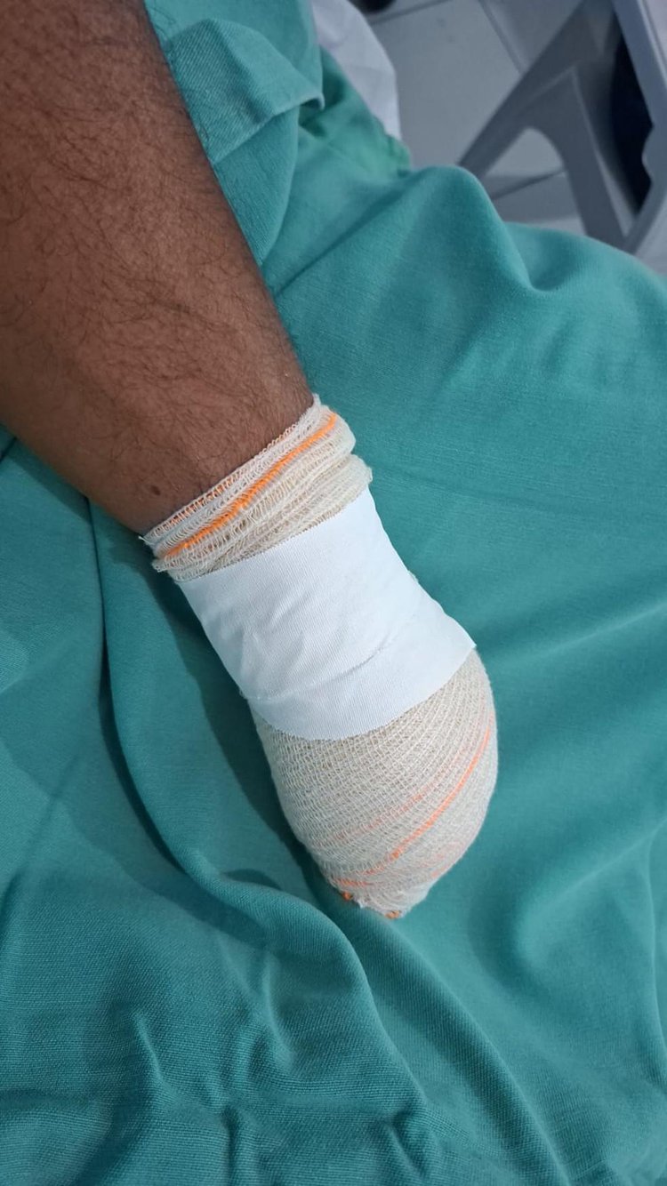 Homem tem a mão decepada após briga por terreno em Campo Maior (PI).