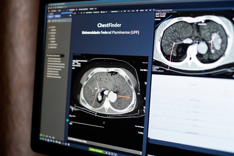 IA promete revolucionar a identificação dessas condições em exames de tomografia computadorizada.