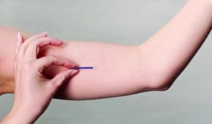 Implanon: anticoncepcional em implante com eficácia de até 3 anos (Foto: Reprodução)