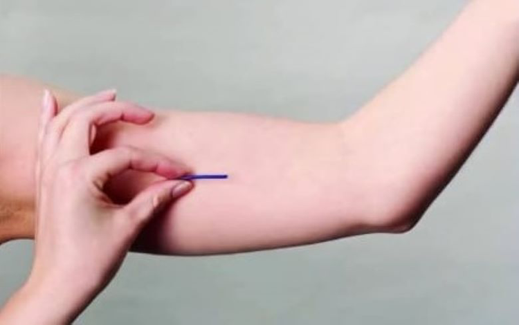 Implanon: anticoncepcional em implante com eficácia de até 3 anos