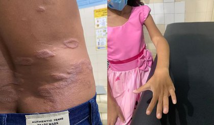 Piauí é o 5o estado brasileiro com mais casos de hanseníase. (Foto: Reprodução) Piauí é o 5o estado brasileiro com mais casos de hanseníase. (Foto: Reprodução)